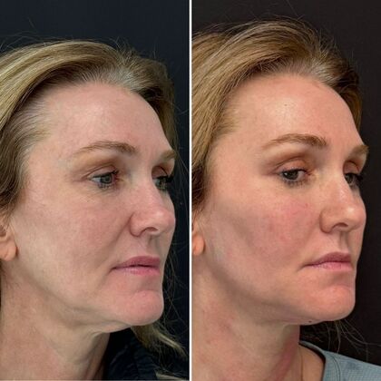 TRL Laser Skin Resurfacing: Case 1 - Right Profile - Before and After
