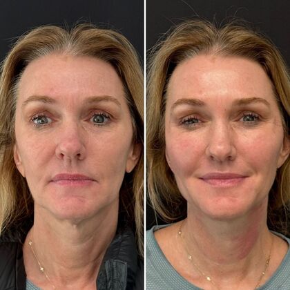 TRL Laser Skin Resurfacing Case 1