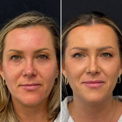TRL Laser Skin Resurfacing Case 2