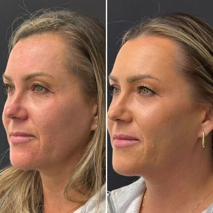 TRL Laser Skin Resurfacing: Case 2 - Left Profile - Before and After