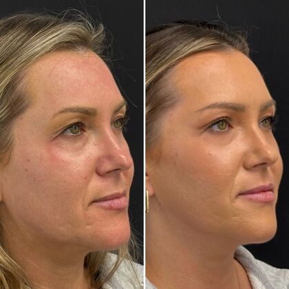 TRL Laser Skin Resurfacing: Case 2 - Right Profile - Before and After