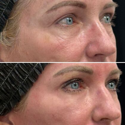 TRL Laser Skin Resurfacing: Case 3 - Right Profile - Before and After