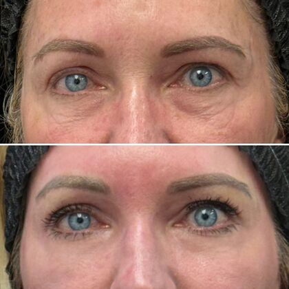 TRL Laser Skin Resurfacing Case 3