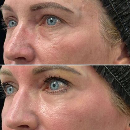 TRL Laser Skin Resurfacing: Case 3 - Left Profile - Before and After