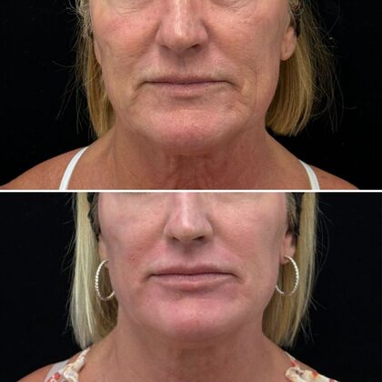 TRL Laser Skin Resurfacing Case 4