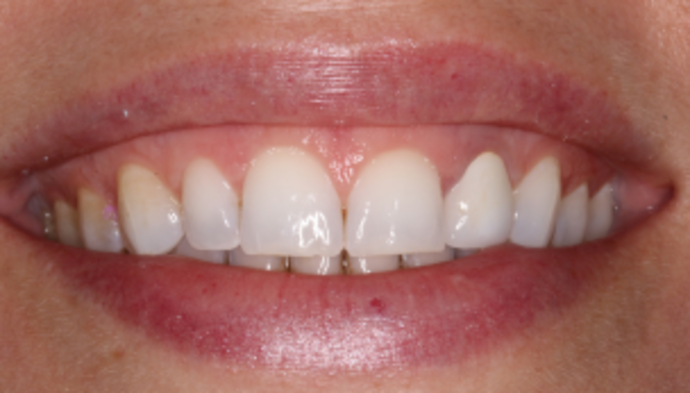 Smile Makeover Case 28 - Before