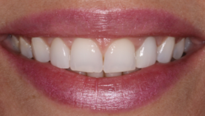 Smile Makeover Case 28 - After