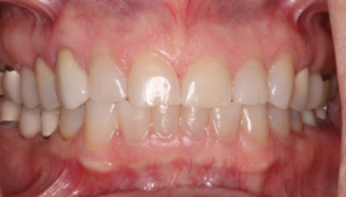 Smile Makeover Case 29 - Before