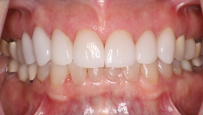 Smile Makeover Case 29 - After