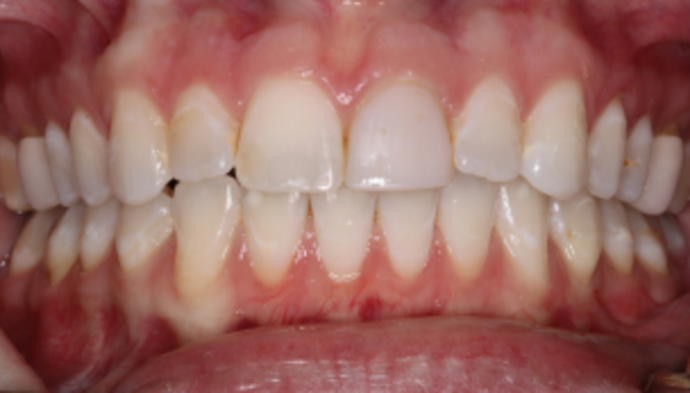 Smile Makeover Case 30 - Before