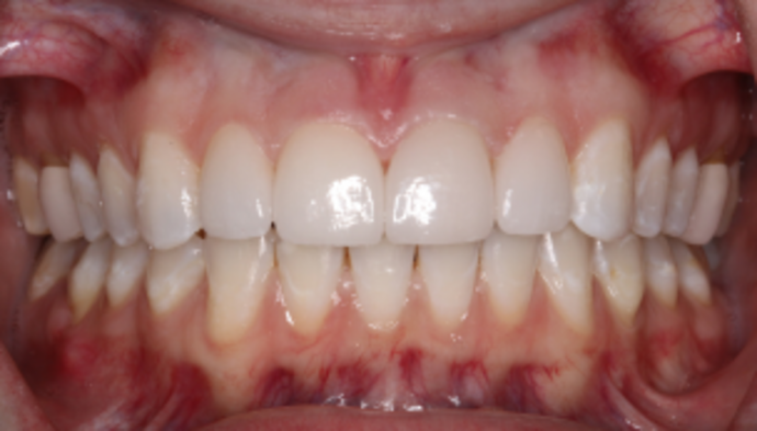 Smile Makeover Case 30 - After