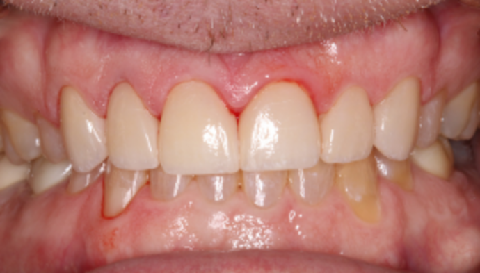Smile Makeover Case 31 - After