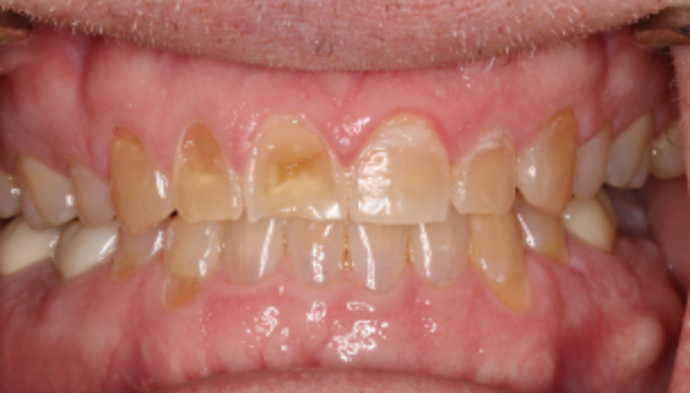 Smile Makeover Case 31 - Before