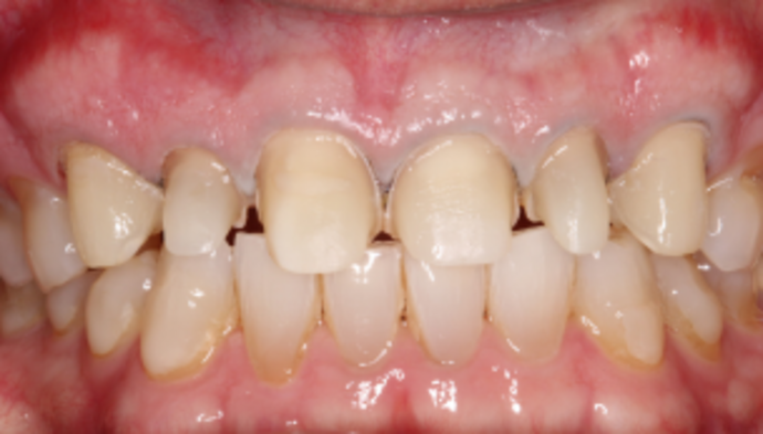Smile Makeover Case 32 - Before