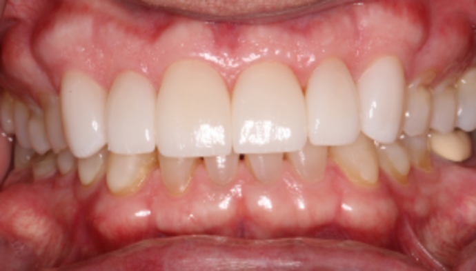 Smile Makeover Case 32 - After
