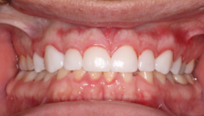 Smile Makeover Case 33 - After
