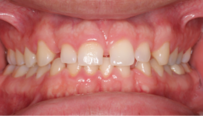 Smile Makeover Case 33 - Before