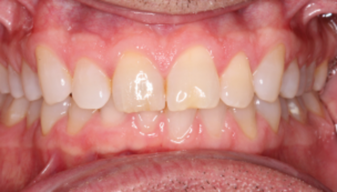 Smile Makeover Case 34 - Before