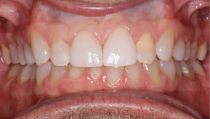 Smile Makeover Case 34 - After