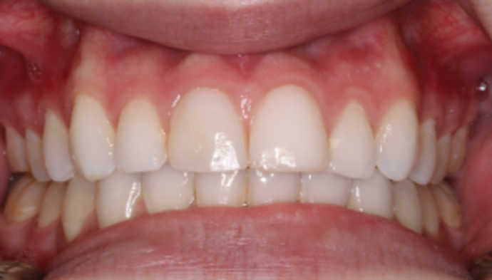Smile Makeover Case 35 - Before