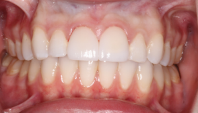 Smile Makeover Case 35 - After