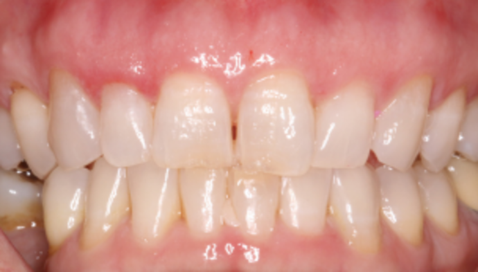 Smile Makeover Case 36 - Before