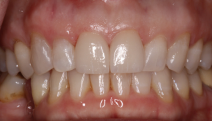 Smile Makeover Case 36 - After