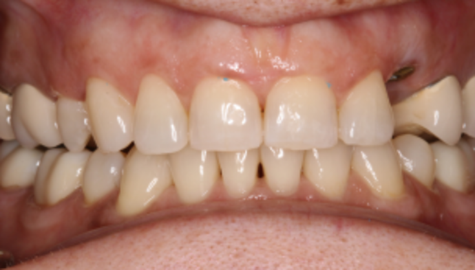 Smile Makeover Case 37 - Before