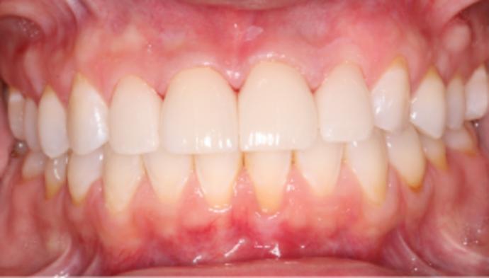 Smile Makeover Case 38 - After