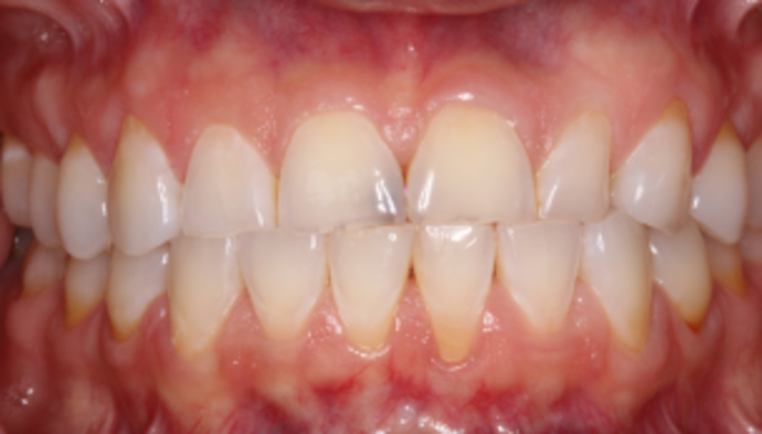 Smile Makeover Case 38 - Before