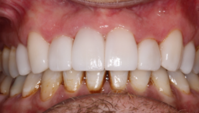 Smile Makeover Case 39 - After