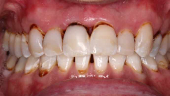 Smile Makeover Case 39 - Before