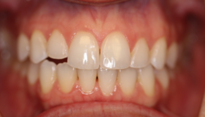 Smile Makeover Case 40 - Before