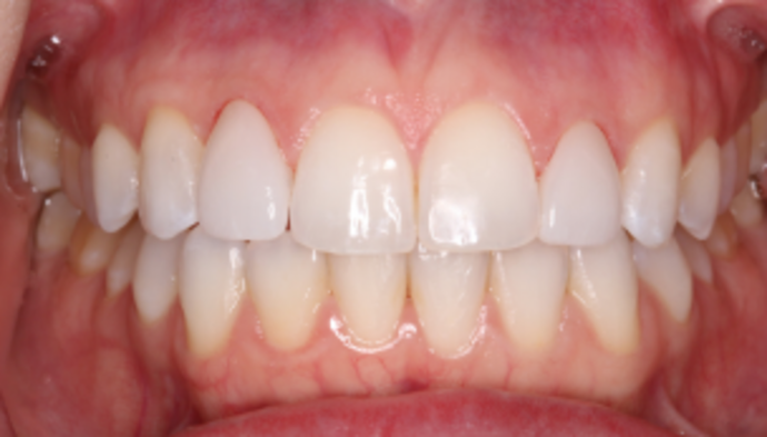 Smile Makeover Case 40 - After