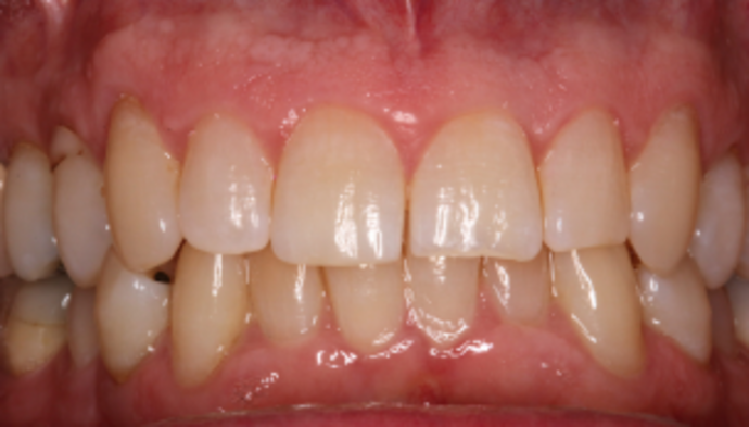 Smile Makeover Case 41 - Before