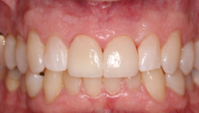 Smile Makeover Case 41 - After