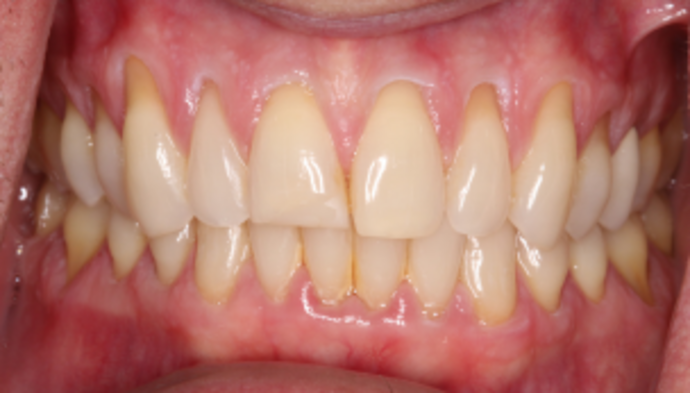 Veneers Case 13 - Before