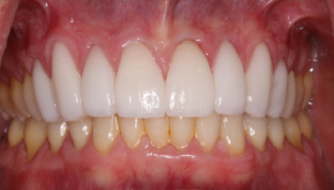 Veneers Case 13 - After
