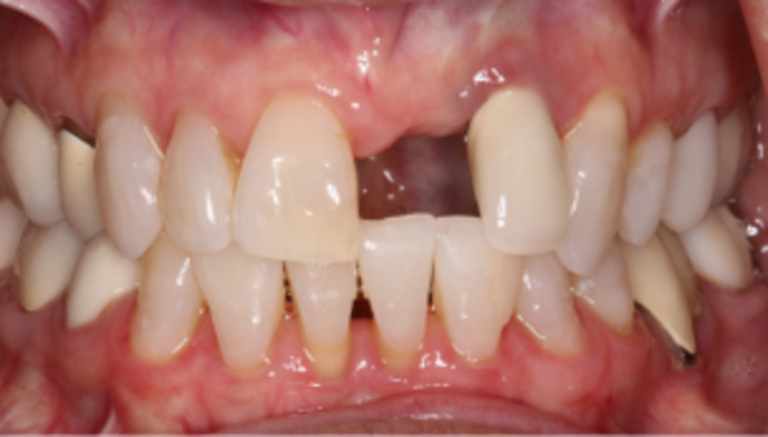 Full Mouth Reconstruction Case 6 - Before