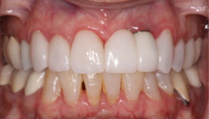 Full Mouth Reconstruction Case 6 - After