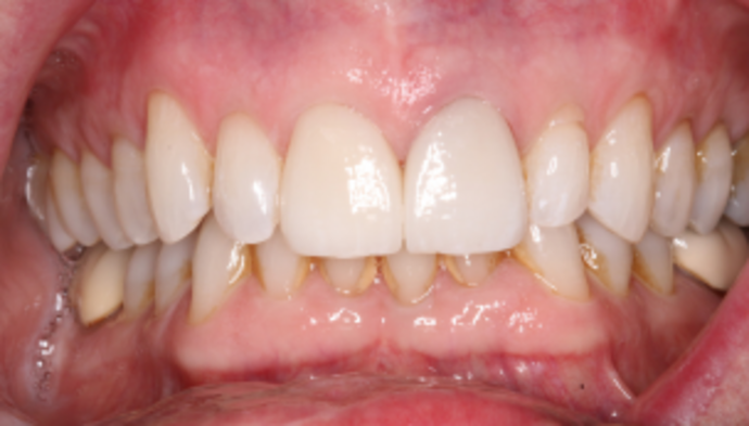 Full Mouth Reconstruction Case 7 - After
