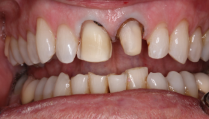 Full Mouth Reconstruction Case 7 - Before