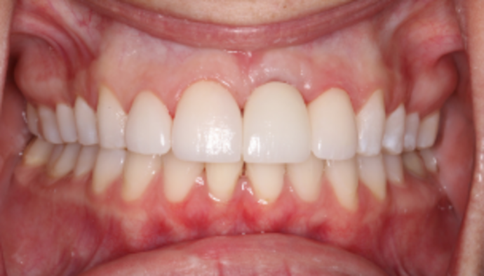 Dental Implants Case 2 - After