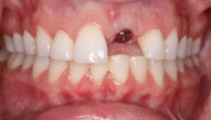 Dental Implants Case 2 - Before