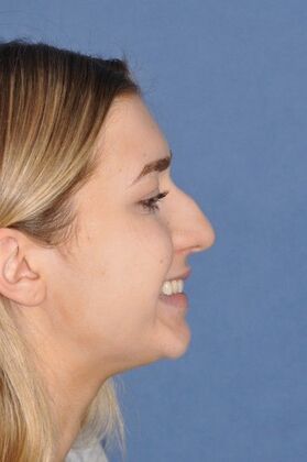 Rhinoplasty: Young lady with a bump and tip droop on smiling at 1 year after - Before