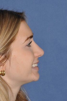 Rhinoplasty: Young lady with a bump and tip droop on smiling at 1 year after - After