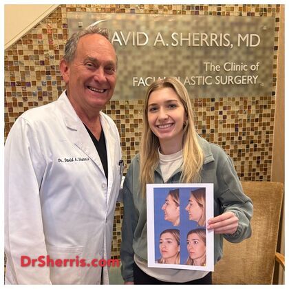 Rhinoplasty: Young lady with a bump and tip droop on smiling at 1 year after - After