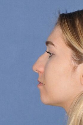 Rhinoplasty: Young lady with a bump and tip droop on smiling at 1 year after - Before