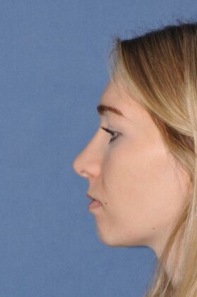 Rhinoplasty: Young lady with a bump and tip droop on smiling at 1 year after - After