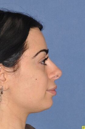 Rhinoplasty: Tip refinement and rotation - After